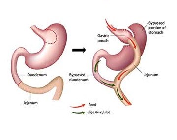 Gastric bypass in iran