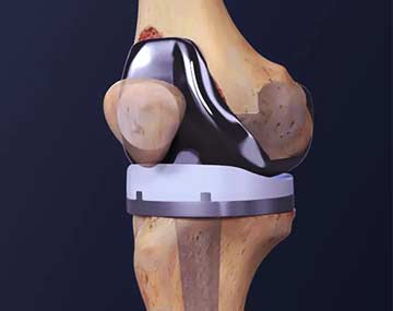 Knee Arthroplasty