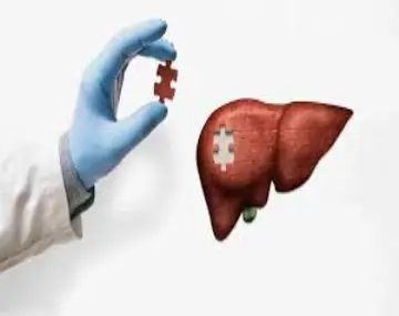 Liver transplant