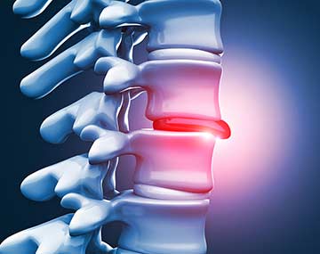 Lumbar Disc Herniation