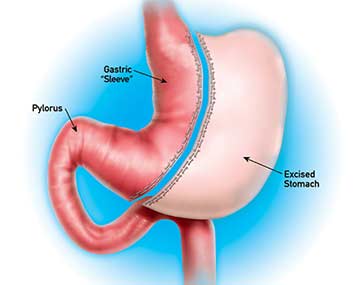 Gastric sleeve