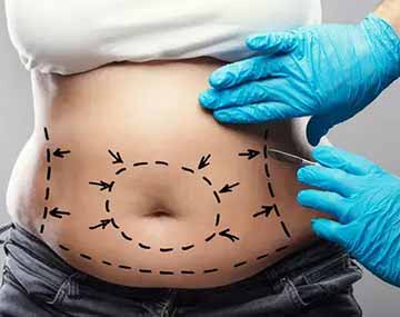 abdominoplasty in iran