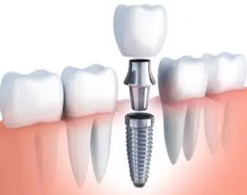 implant